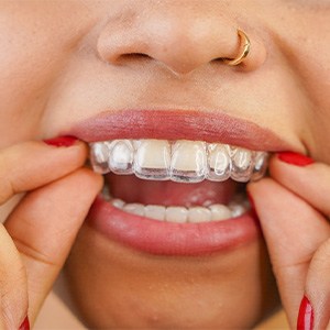Woman putting in her clear aligners.