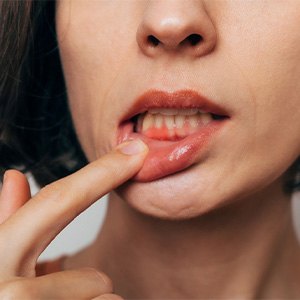 Woman with gum irritation.